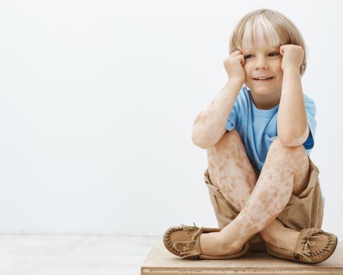 Jak rozpoznać pokrzywkę alergiczną u dzieci?